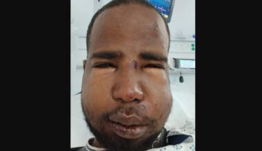 Hussein suffered a broken jaw and nose after being assaulted in Dublin.