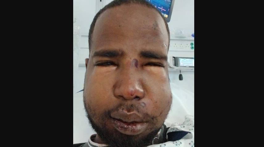 Hussein suffered a broken jaw and nose after being assaulted in Dublin.