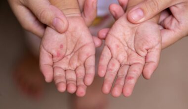 Hand, foot and mouth disease cases surge across Japan