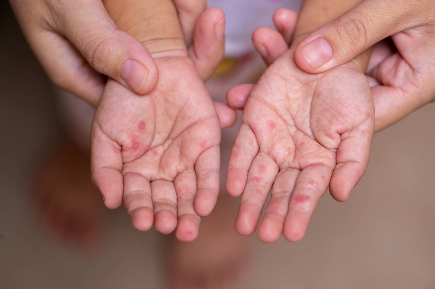 Hand, foot and mouth disease cases surge across Japan