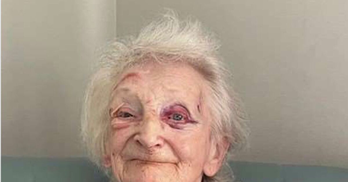 Daughter's horror after finding mum covered in bruises at UK care home | UK | News