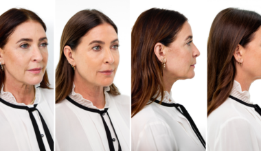 Lisa Snowdon, 54, says she looks ‘10 years younger’ after collagen-boosting treatment
