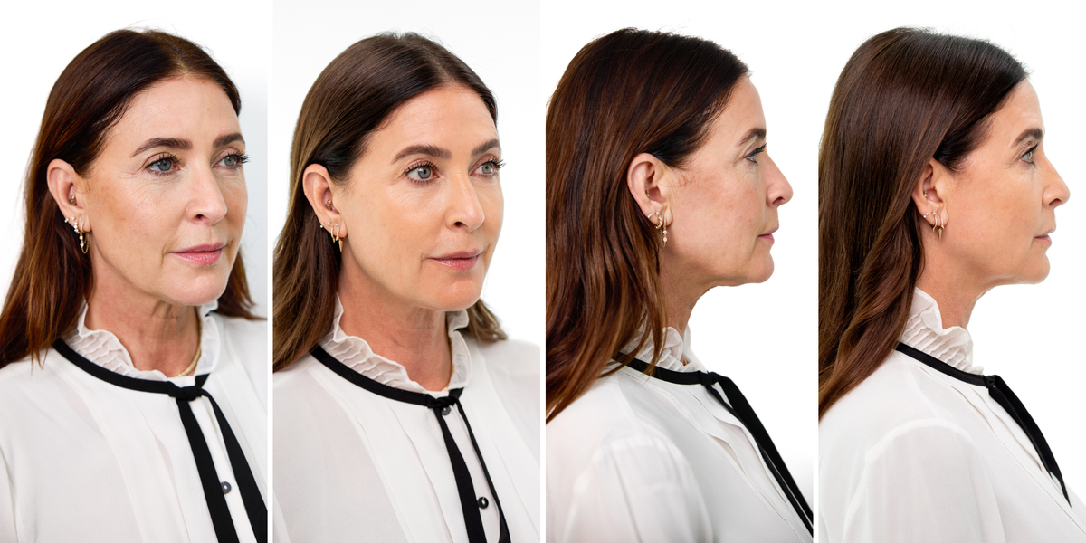 Lisa Snowdon, 54, says she looks ‘10 years younger’ after collagen-boosting treatment
