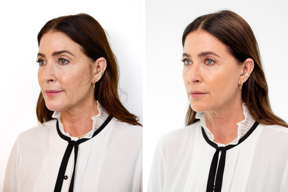 lisa snowdon sculptra