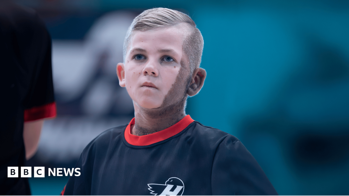 A teenage boy wearing a sports kit looks up. He has blonde hair, blue eyes and a birthmark across one side of his face and neck.
