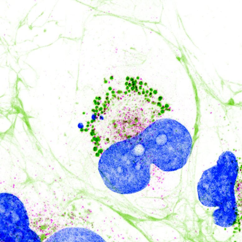 Collagen Droplets Inside Human Liver Cells