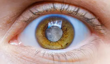 cataract