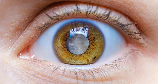 cataract