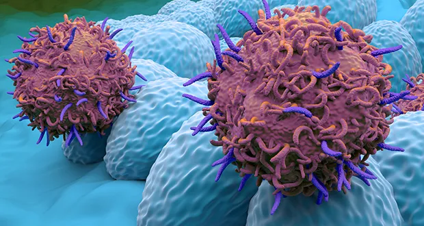endometrial cancer