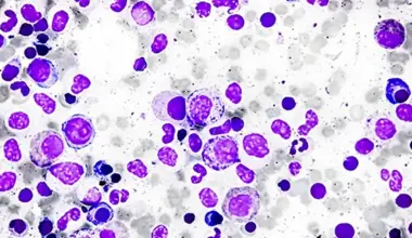 multiple myeloma