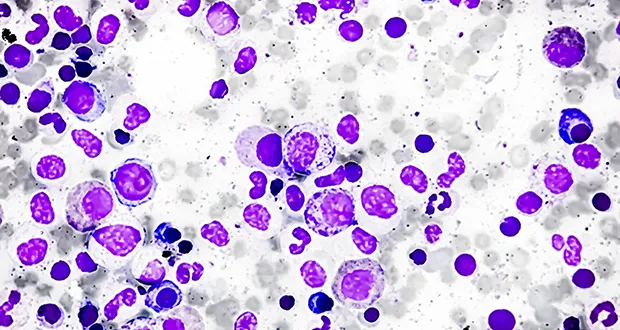 multiple myeloma