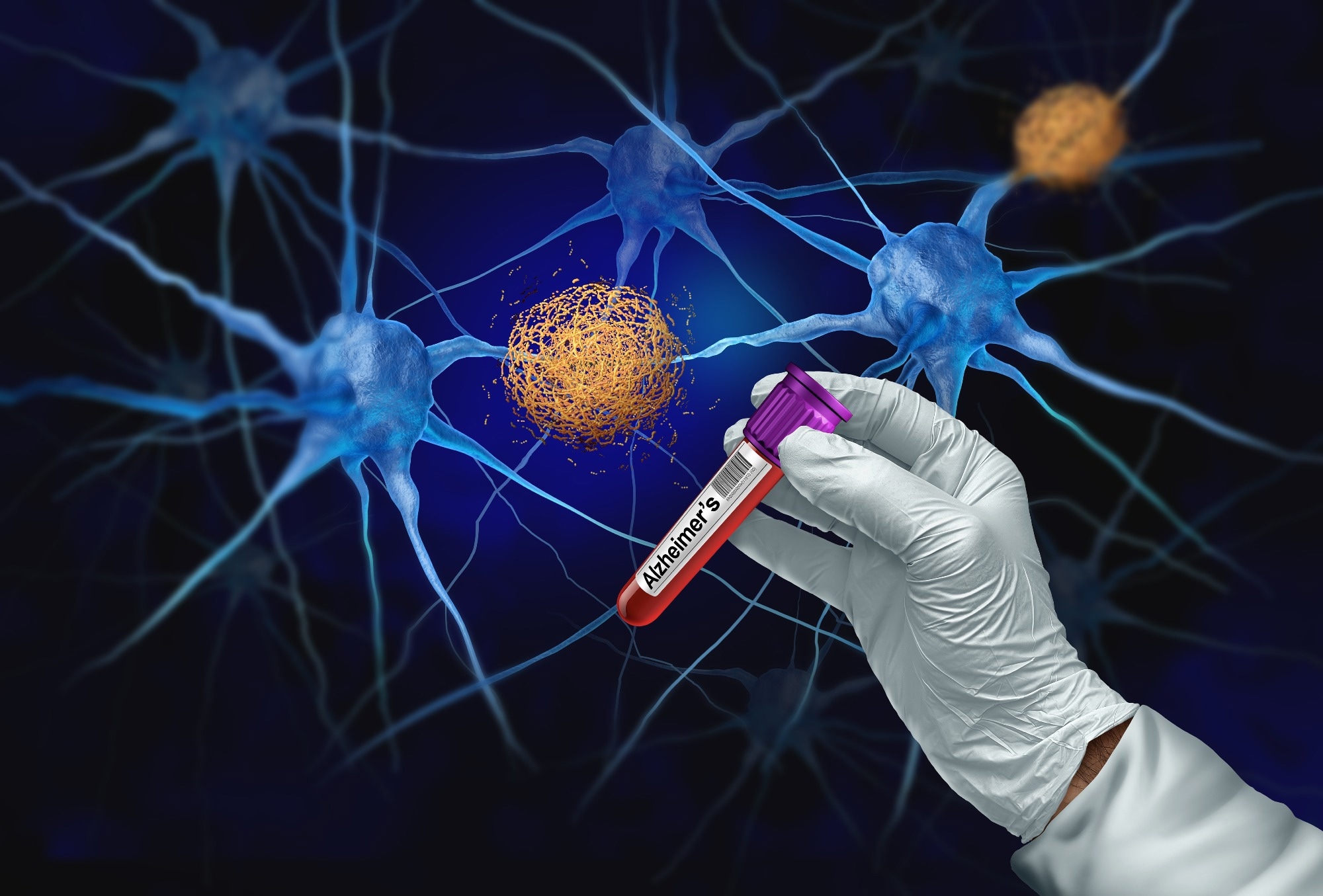Study: Prognostic Value of Blood-Based P-Tau217 Levels for Progression to Cognitive Impairment. Image Credit: Lightspring / Shutterstock