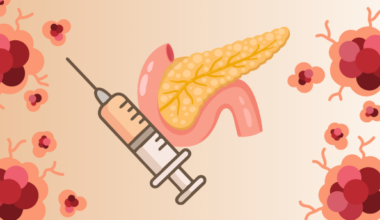KRAS Vaccine For Pancreatic Cancer Shines In Phase I Trial