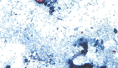 Cyclosporiasis outbreak spreads in US