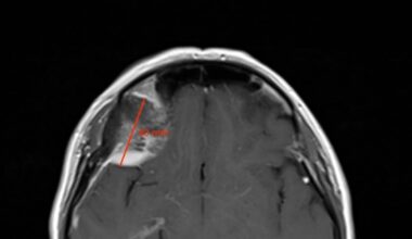Surgeons remove brain tumour through eyelid in Irish medical first – The Irish Times