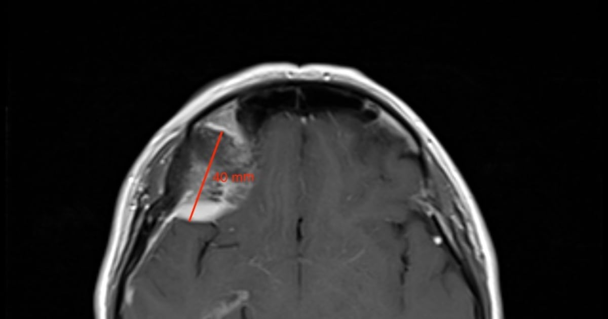 Surgeons remove brain tumour through eyelid in Irish medical first – The Irish Times