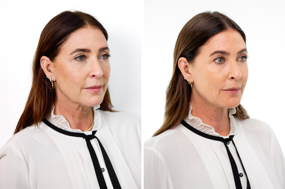 lisa snowdon sculptra