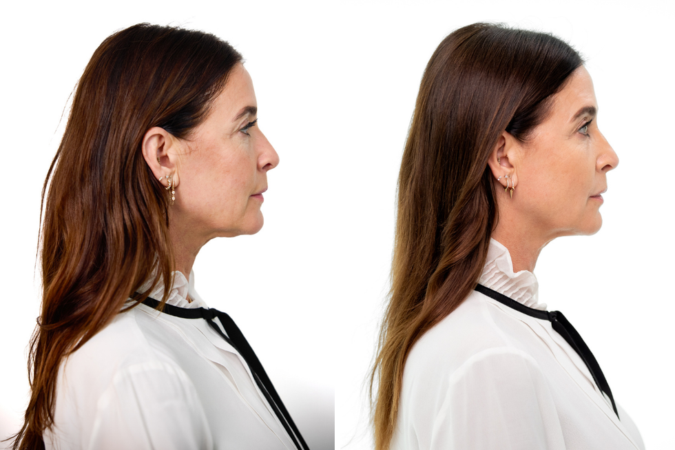 lisa snowdon sculptra