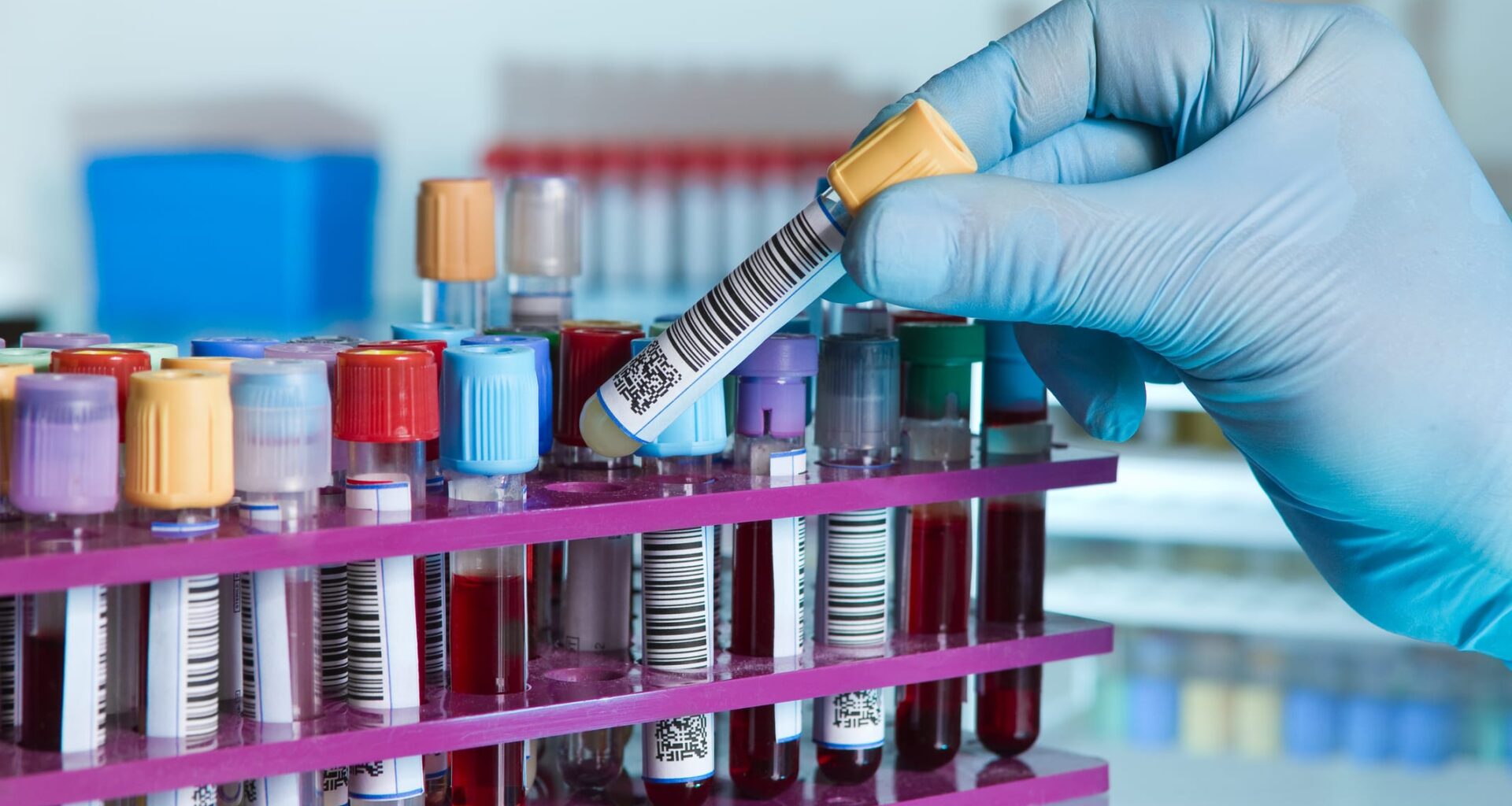 FDA Clears Diazyme Lipoprotein(a) Assay for Cardiovascular Risk Testing