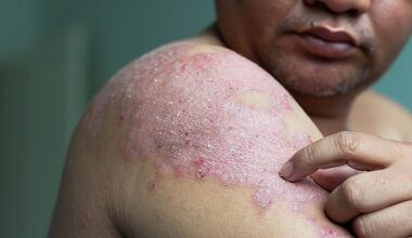 Skip the Stairs: The Elevator Approach to Psoriasis