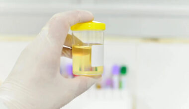 Urine biopsy offers a more accurate way to detect bladder, kidney and prostate cancers