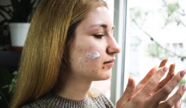 More Than Antibacterial: Triple-combination Acne Gel Takes Aim at C. acnes Virulence Factors