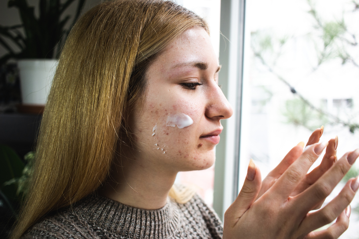 More Than Antibacterial: Triple-combination Acne Gel Takes Aim at C. acnes Virulence Factors