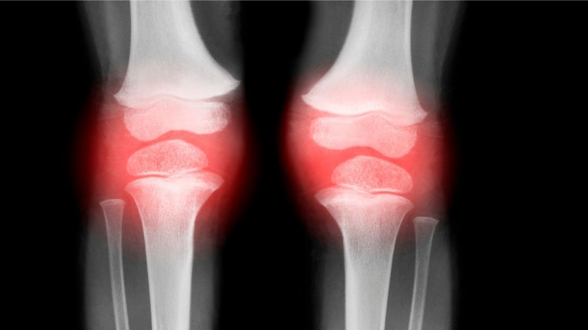 Single Injection Reverses Osteoarthritis in Animals in Just 4 Weeks : ScienceAlert