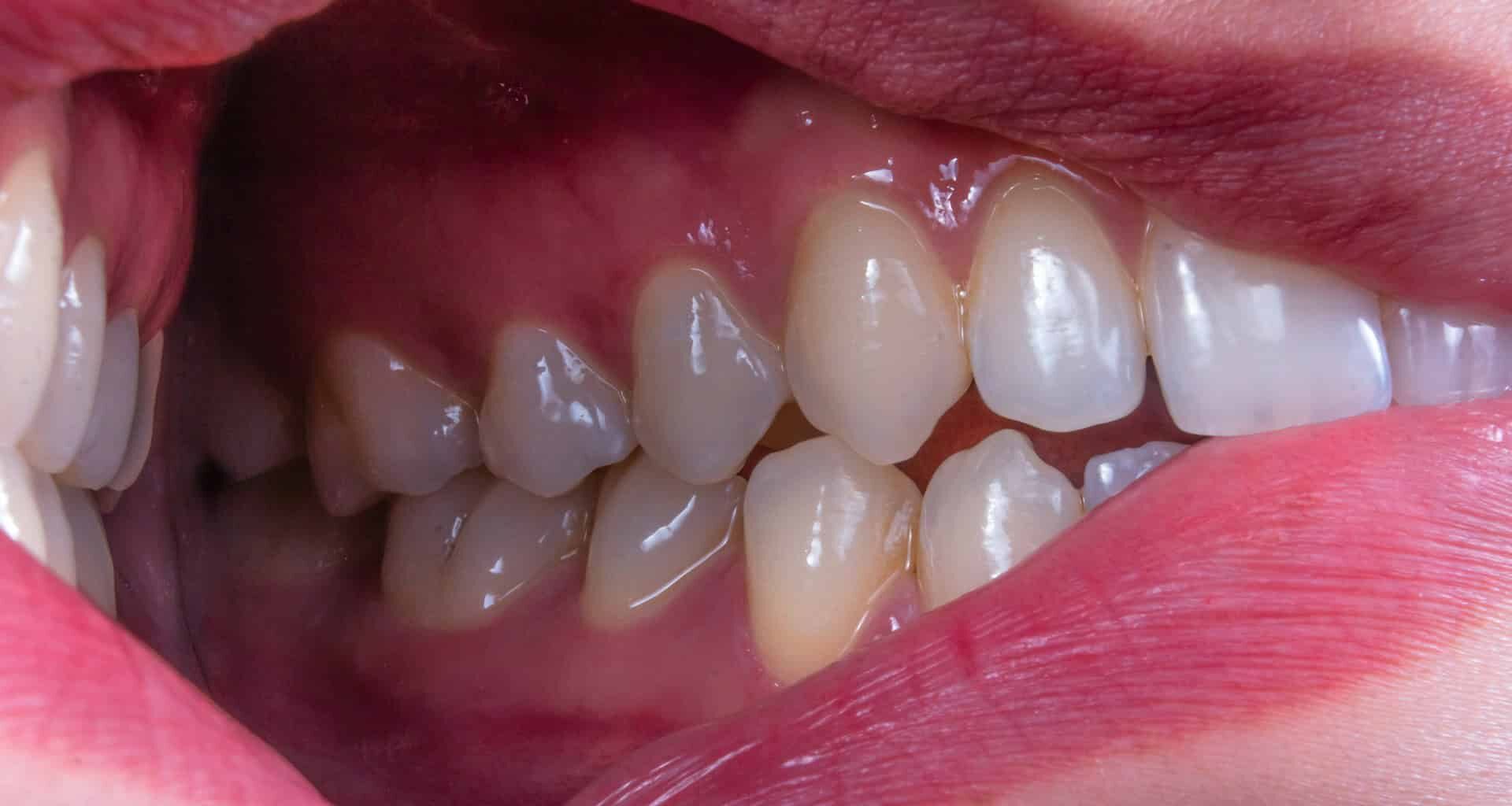 A Five-Day Fasting Diet Could Help Ease Gum Disease Inflammation