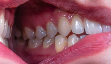 A Five-Day Fasting Diet Could Help Ease Gum Disease Inflammation