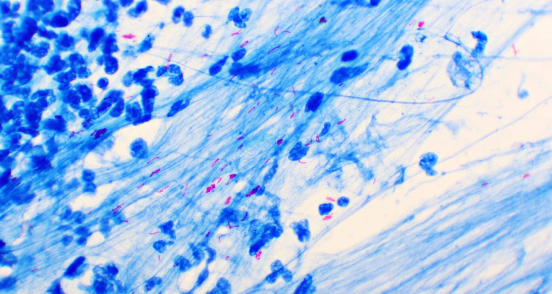 Intelligenome, Cornell Partner on Portable TB Diagnostic