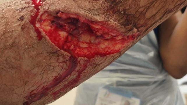 An injury to a man's leg after he was bitten by a shark bite off the coast of Co Waterford