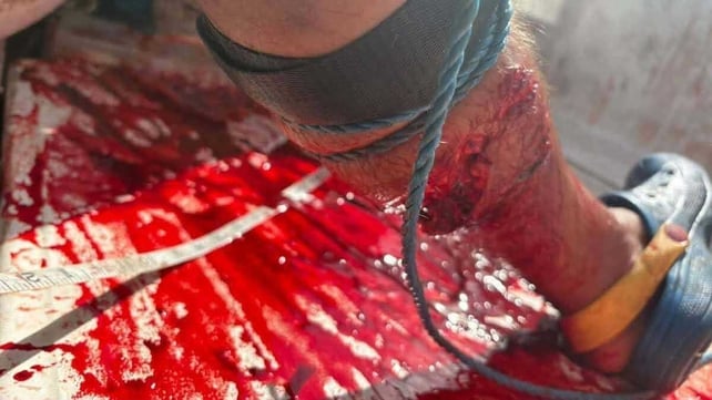 An injury to a man's leg after he was bitten by a shark bite off the coast of Co Waterford
