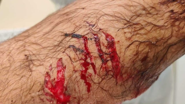 An injury to a man's leg after he was bitten by a shark bite off the coast of Co Waterford