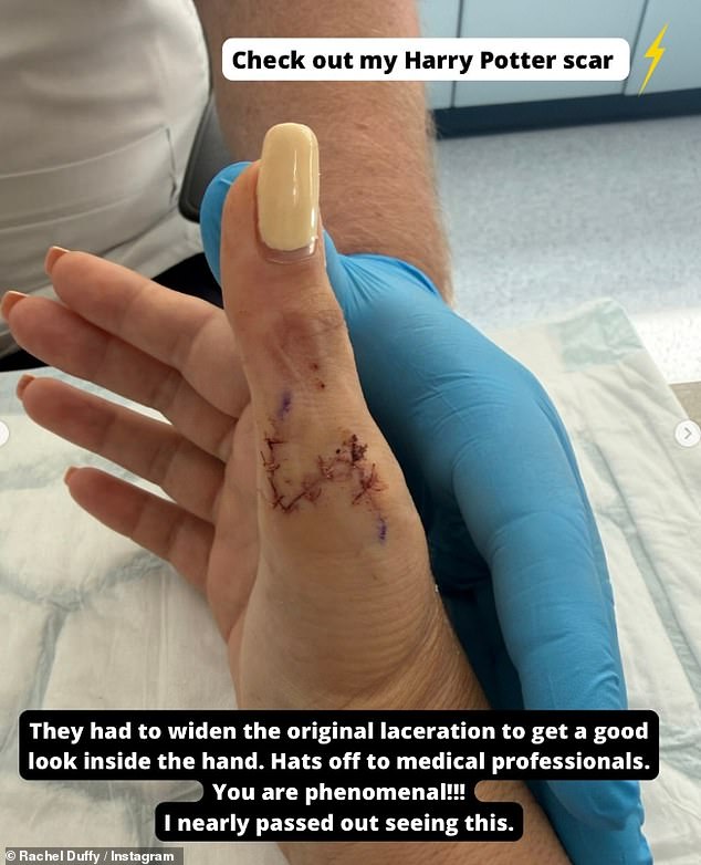 The BBC star, 42, shared on Instagram that she was forced to undergo surgery on her right hand after 'severing her dorsal nerve and partially lacerated her tendon'