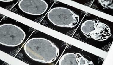 New AI brain scans could help identify dementia earlier | Health