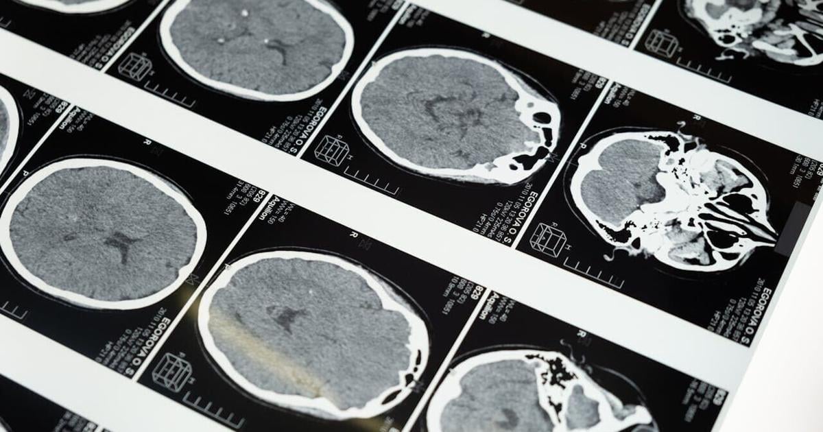 New AI brain scans could help identify dementia earlier | Health
