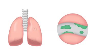 Women with shorter reproductive lifespan face higher risk of developing bronchiectasis
