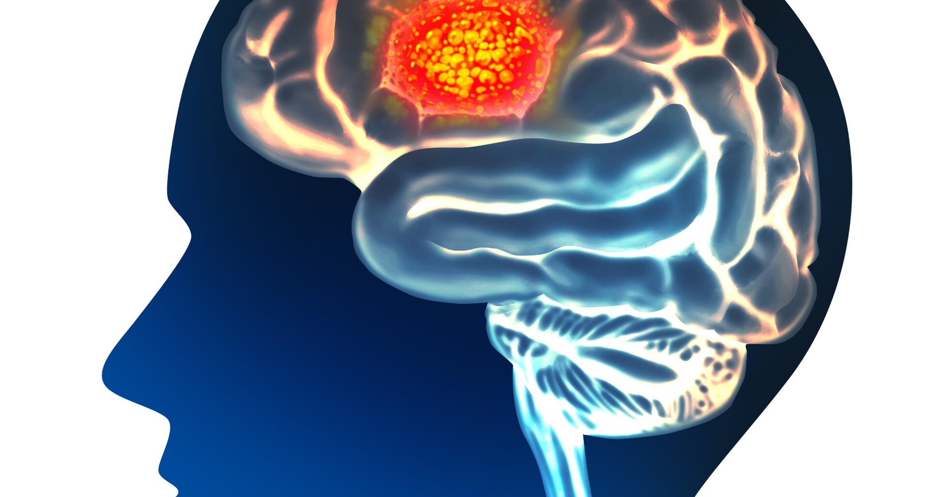 Large Multicenter Study Evaluates LITT for Primary and Metastatic Brain Tumors