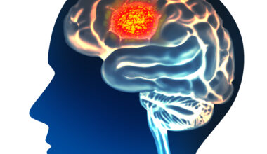 Large Multicenter Study Evaluates LITT for Primary and Metastatic Brain Tumors