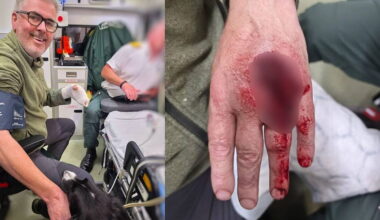 Photographer James O'Donnell opens up about near-death "freak accident" fire