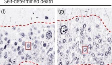 Possible biomarker for suicidal thoughts identified • healthcare-in-europe.com