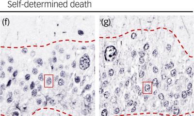Possible biomarker for suicidal thoughts identified • healthcare-in-europe.com