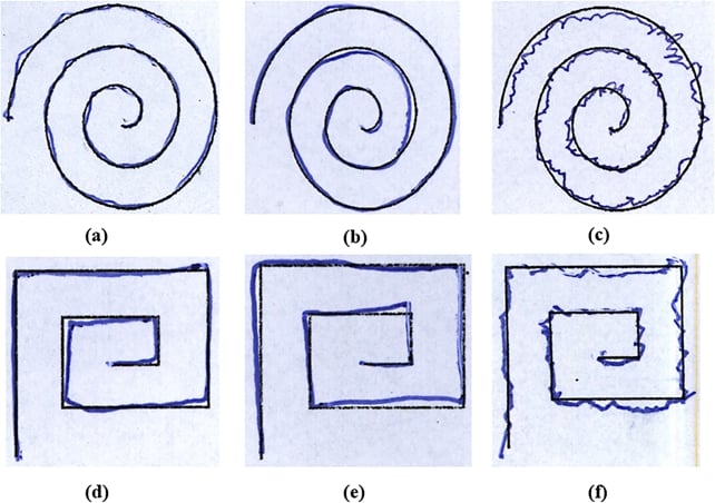 The Way You Draw Can Reveal Parkinson's Disease With Up to 99% Accuracy, Study Reveals