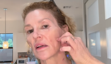 Brandi Glanville shares emotional update on facial parasite: ‘I want my life back’