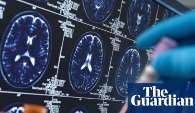 Researchers warn social media driving harmful misuse of Alzheimer’s blood tests | Alzheimer's