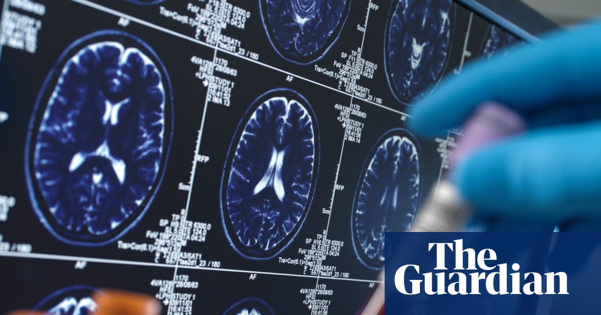 Researchers warn social media driving harmful misuse of Alzheimer’s blood tests | Alzheimer's