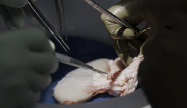 Recipients of gene-edited pig kidneys successfully receive human organs