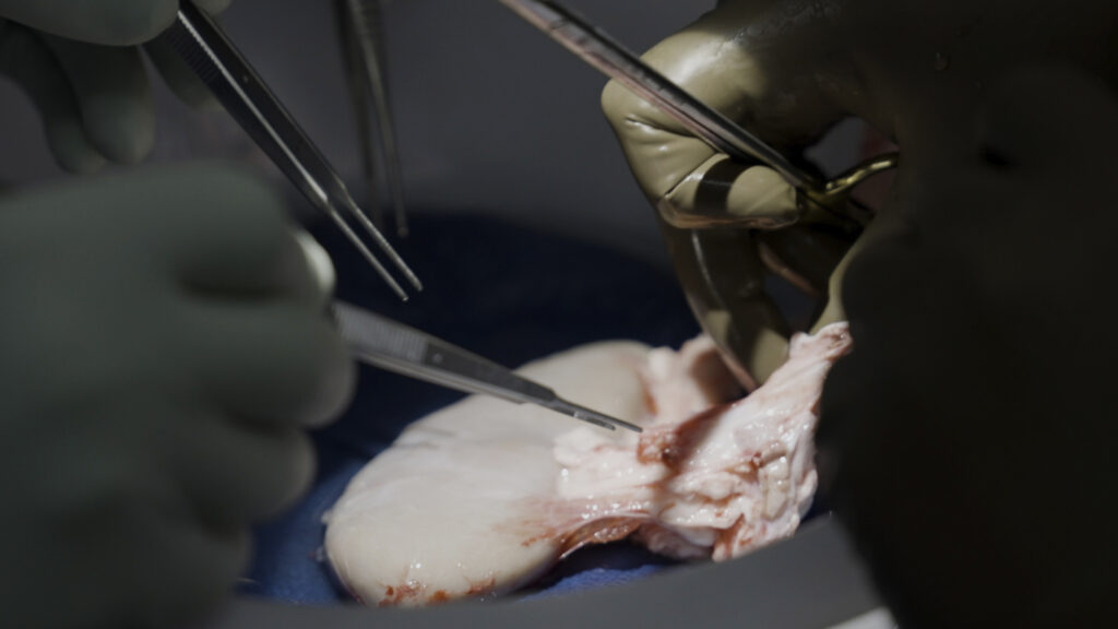 Recipients of gene-edited pig kidneys successfully receive human organs