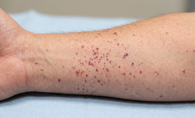 Cryoglobulinemic Vasculitis on skin from Hepatitis C